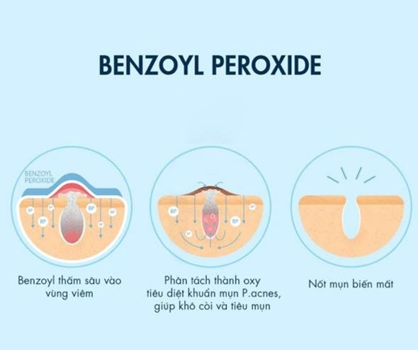 review-chi-tiet-Benzoyl-peroxide-la-gi-2